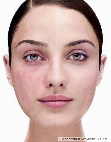 Лечение купероза