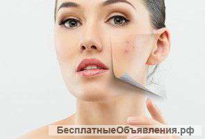 Лечение акне