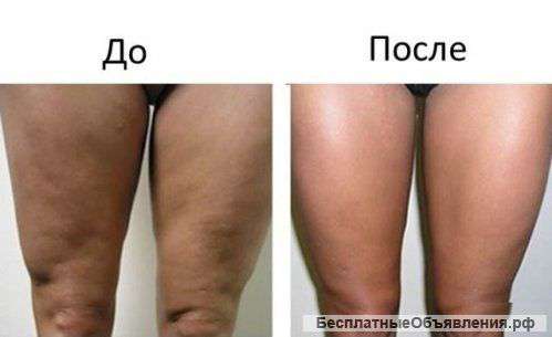 LPG Массаж